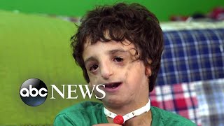 Boy living with Treacher Collins has 53 surgeries by age 11: 20/20 Part 2