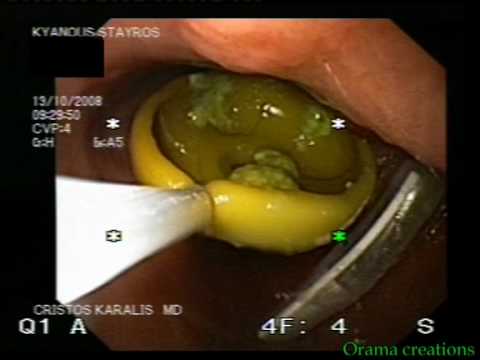 Gastrostomy Tube Removal