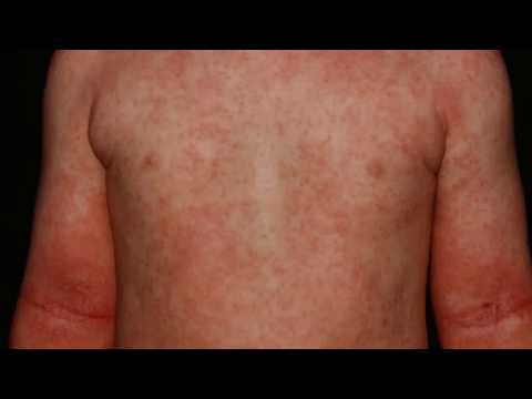 La dermatite di atopic quali analisi devono esser consegnate Cura di psoriasi nervosa da rimedi di gente