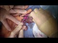 Dr Pimple Popper S03E02 The Incredible Shrinking Lipoma