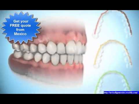 Invisalign Mexico