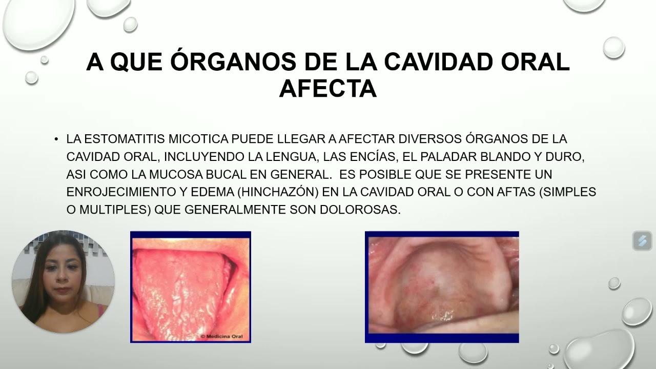 patologia la Estomatitis Micotica