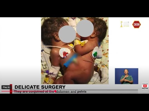 Kenyatta National Hospital is currently managing a set of conjoined twins