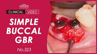 Download lagu Simple Buccal GBR with Collagen Membrane [Dr. Kim Jaeyoon] mp3