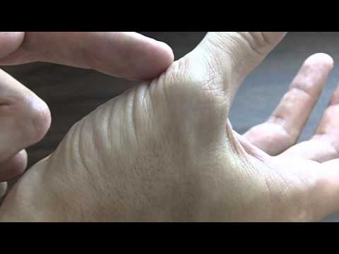 Recognizing Thumb Muscle Atrophy - Carpal Tunnel Syndrome