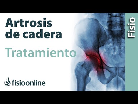 Artrosis de Cadera Tratamiento