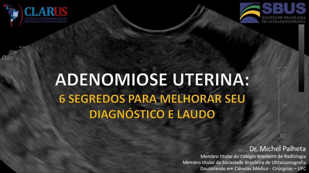 AULA DO CURSO DE ULTRASSONOGRAFIA PARA MÉDICOS - ADENOMIOSE