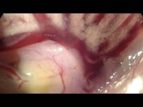 Video of a living schistosome worm inside the hepatic portal vein of a mouse
