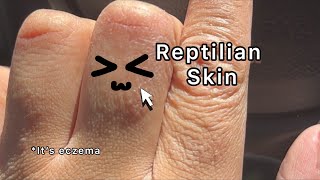 Reptilian Skin Concerns | Curly Cami Channel