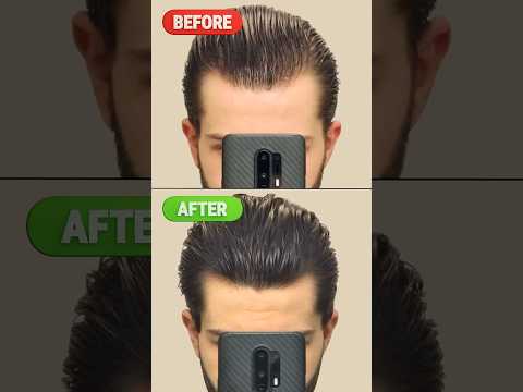 My insane hair regrowth journey (Time-Lapse)