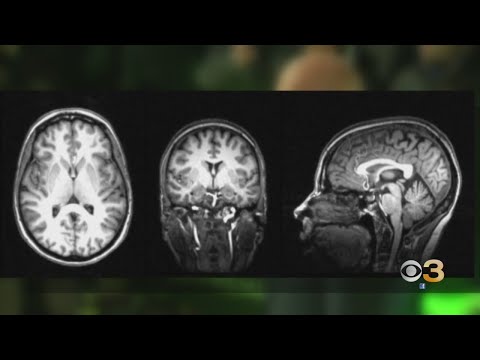 Local Doctor Explains Aphasia Disorder That's Impacting Bruce Willis' Acting Career