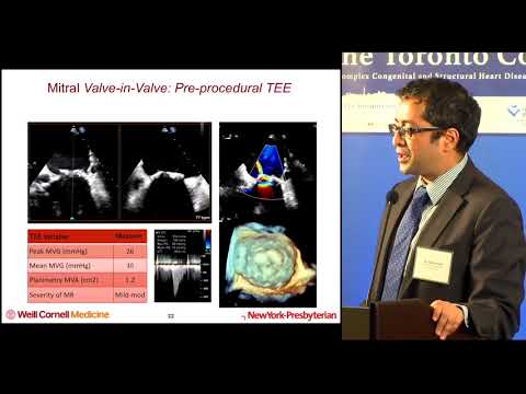 Mitral VIV, Valve in Ring, Valve in MAC