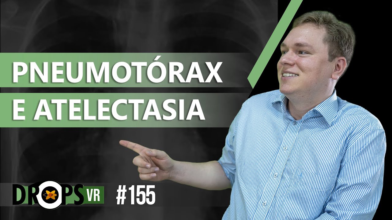 PNEUMOTÓRAX E ATELECTASIA DO LOBO SUPERIOR DIREITO