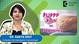 PUPPP Rash in Pregnancy Causes, Symptoms, Prevention & Treatment - Dr. Rasya Dixit | Doctors