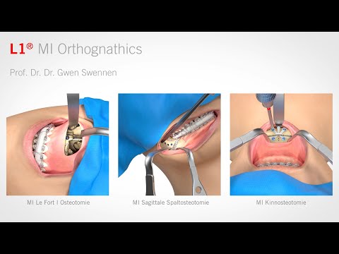 L1® MI Orthognathics (deutsch)