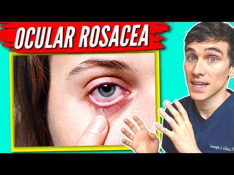 Ocular Rosacea Treatment - 7 Tips to Help get Relief!