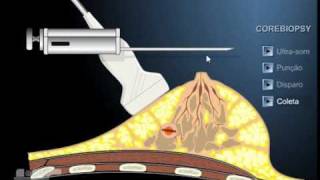 Core biopsy da mama