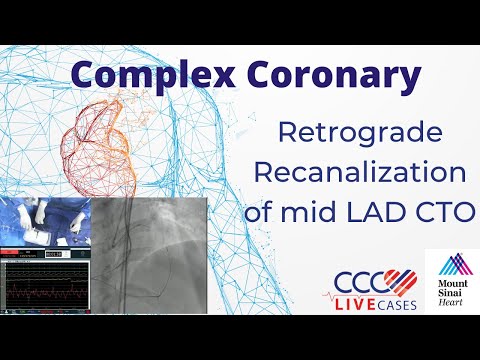 Retrograde Recanalization of mid LAD CTO - March 2022