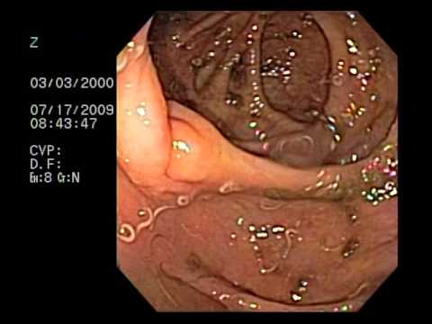 Papilom scuamoas al tratamentului esofagului