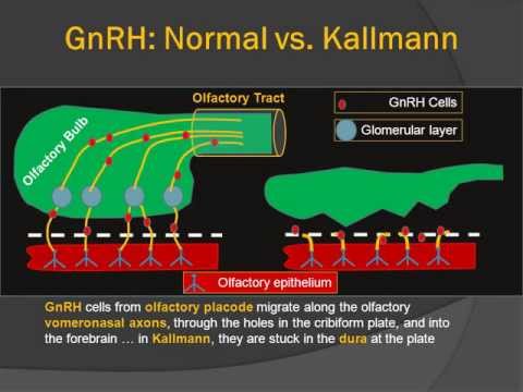 Kallmann Syndrome Fertilitypedia