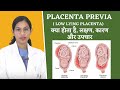 Placenta Previa FAQs By Dr. Richa Vaishnav