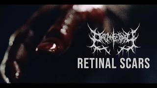Retinal Scars - Organectomy 