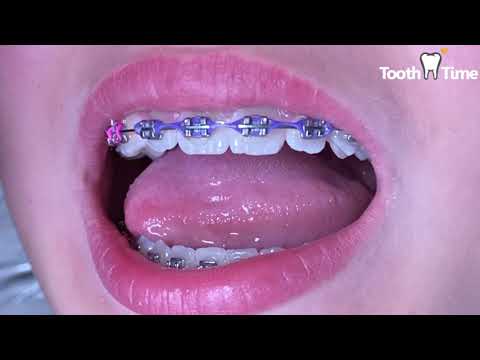 Braces Checkups - 11 years old -1 year & a half in braces- Tooth Time Family Dentistry New Braunfels