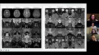 Young People’s Webinar | Connecting MS, NMOSD & MOGAD: Sharing Knowledge and Experiences
