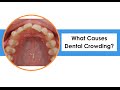 What Causes Dental Crowding?