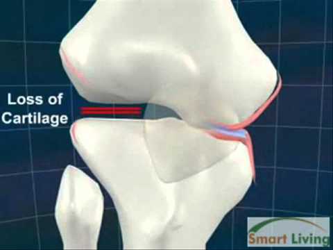 Durere peste cupă în articulația genunchiului