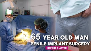 Download lagu 65 Year Old Indian Man | Penile Implant Surgery | Before & After mp3