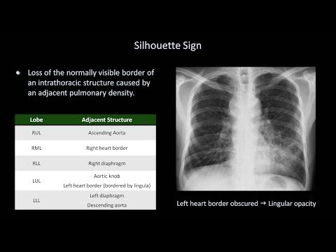 How to Interpret a Chest X-Ray (Lesson 8 - Focal Lung Processes)
