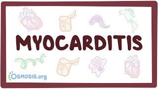 Myocarditis  - causes, symptoms, diagnosis, treatment, pathology