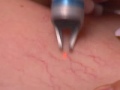 Awesome video showing varicose vein removal ...