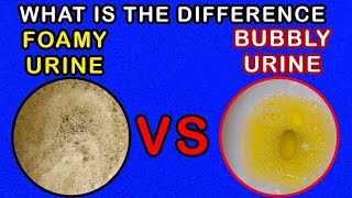 Differences between Foamy Urine Vs Bubbly Urine