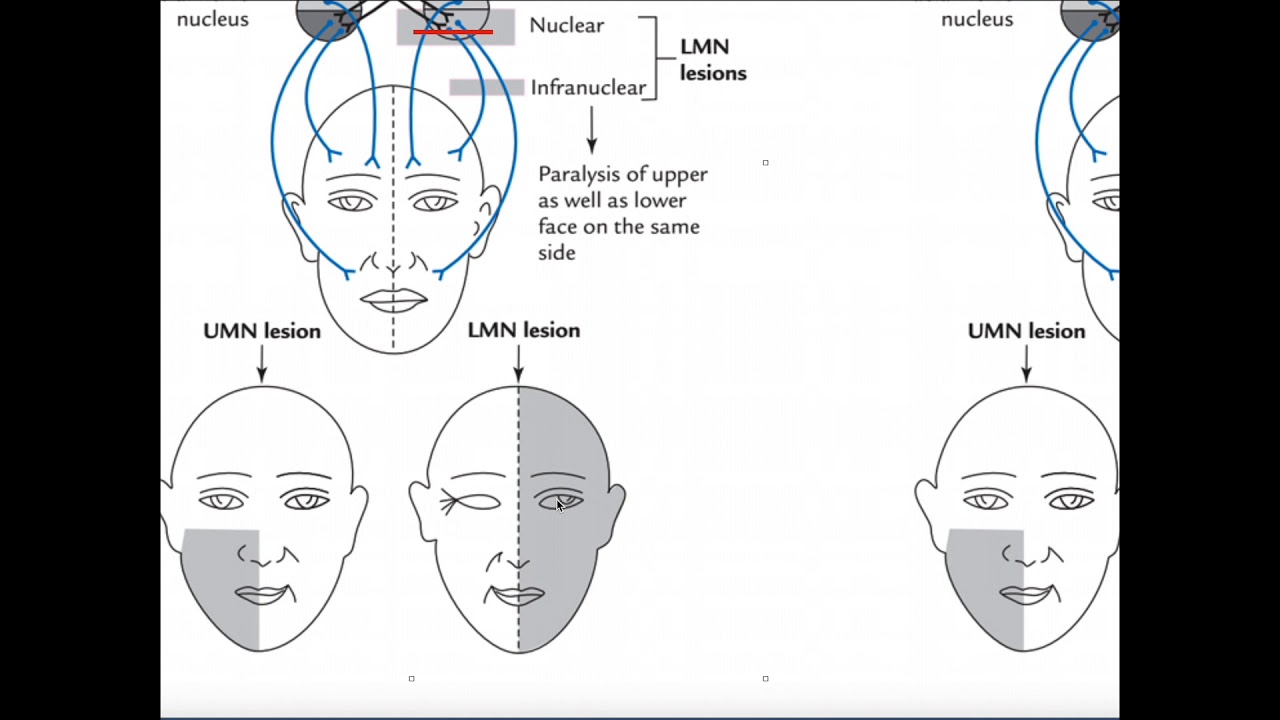 Mechanism of Facial (Bell's) Palsy and Clinical Interpretation