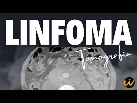 LINFOMA na Tomografia de Tórax, Abdome e Pelve