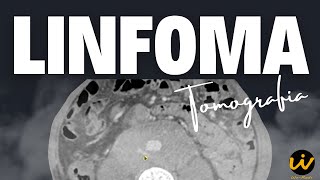 LINFOMA na Tomografia de Tórax, Abdome e Pelve