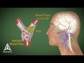3d Medical Animation
