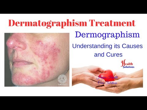 Dermatographism Treatment - Dermographism - Understanding its Causes and Cures Video