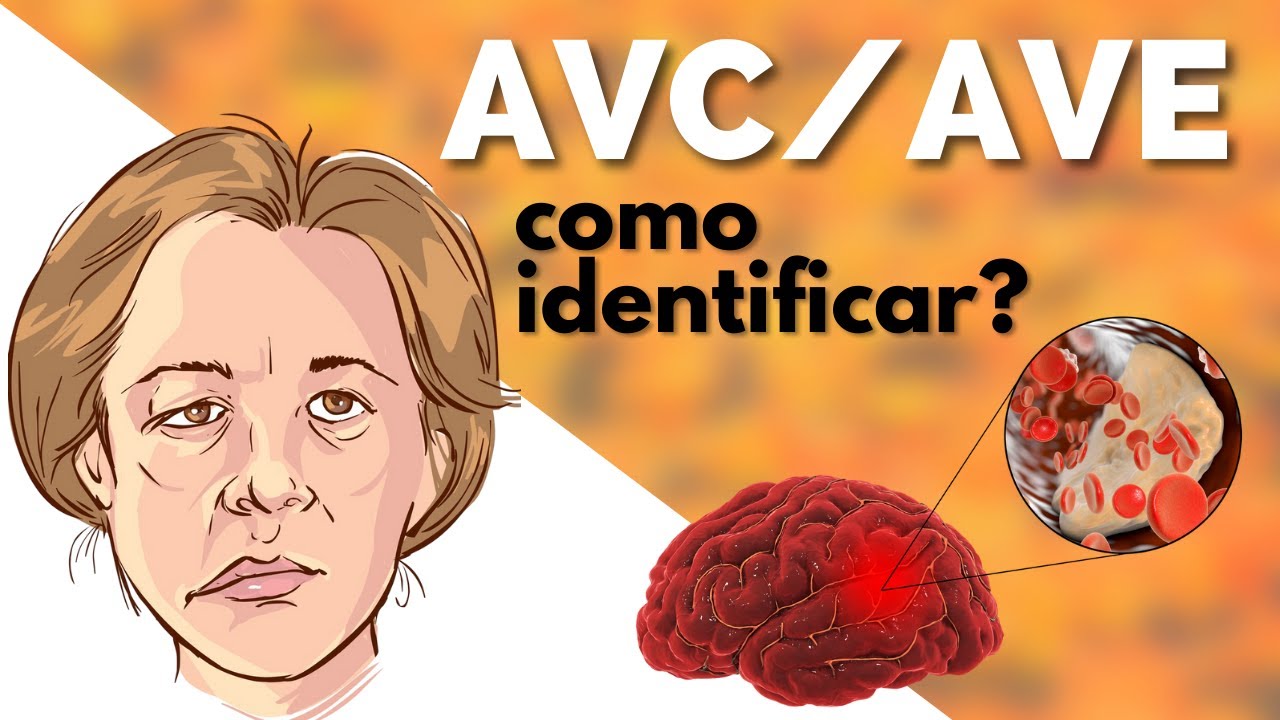 Acidente Vascular Encefálico  - AVC / AVE - O que é o AVE ? Como identificar AVE ? O que fazer AVE ?