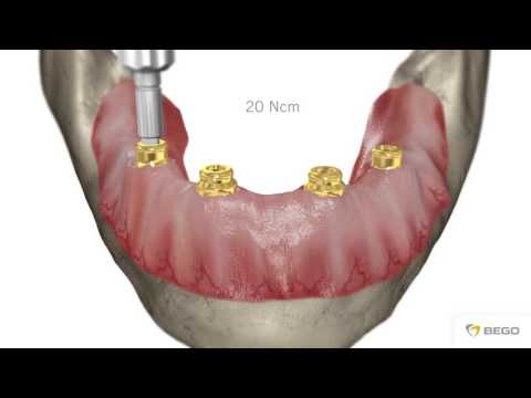 BEGO Implant Systems – MultiPlus MC