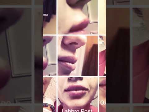 (10 MINUTI)RINOLABIOFILLER