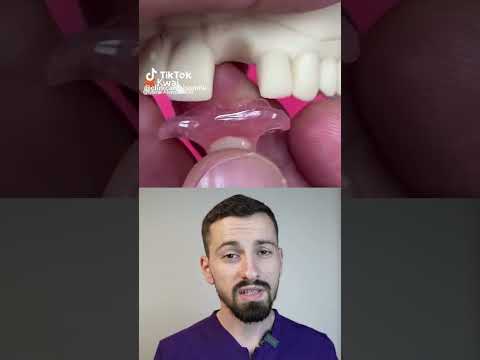 Cum înlocuiești un dinte frontal FĂRĂ implant și FĂRĂ să șlefuiești dinții vecini 🦷✨