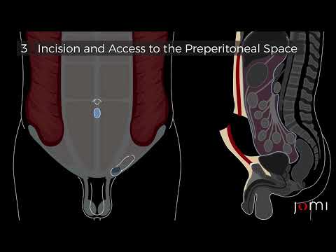 Laparoscopic Totally Extraperitoneal (TEP) Left Indirect Inguinal Hernia Repair with Mesh