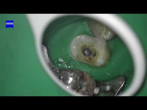 BROKEN INSTRUMENT REMOVAL