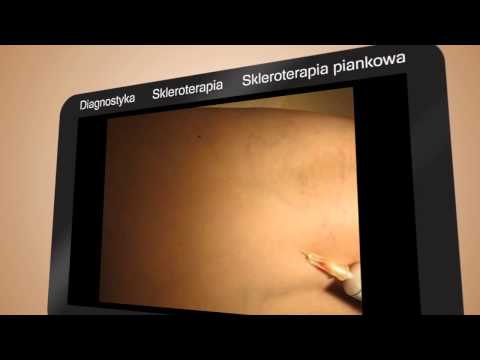 Diagnostyka, leczenie i usuwanie (w tym laserowe usuwanie) żylaków