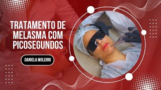 Tratamento de Melasma com Picosegundos Ômer Premium Medical San
