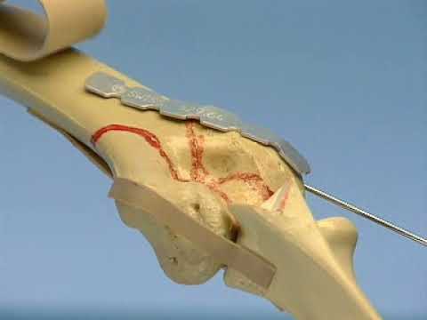 intra articular fracture distal humerus (foamed elbow)