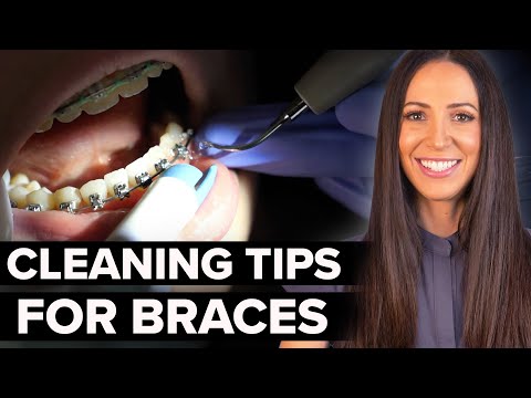 Tips for Cleaning Braces (for dental hygienists)